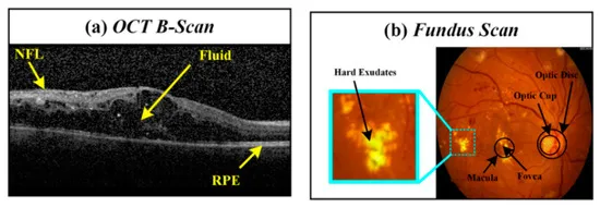 OCT Scan results, fundus and bscan image